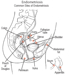 endometriosos